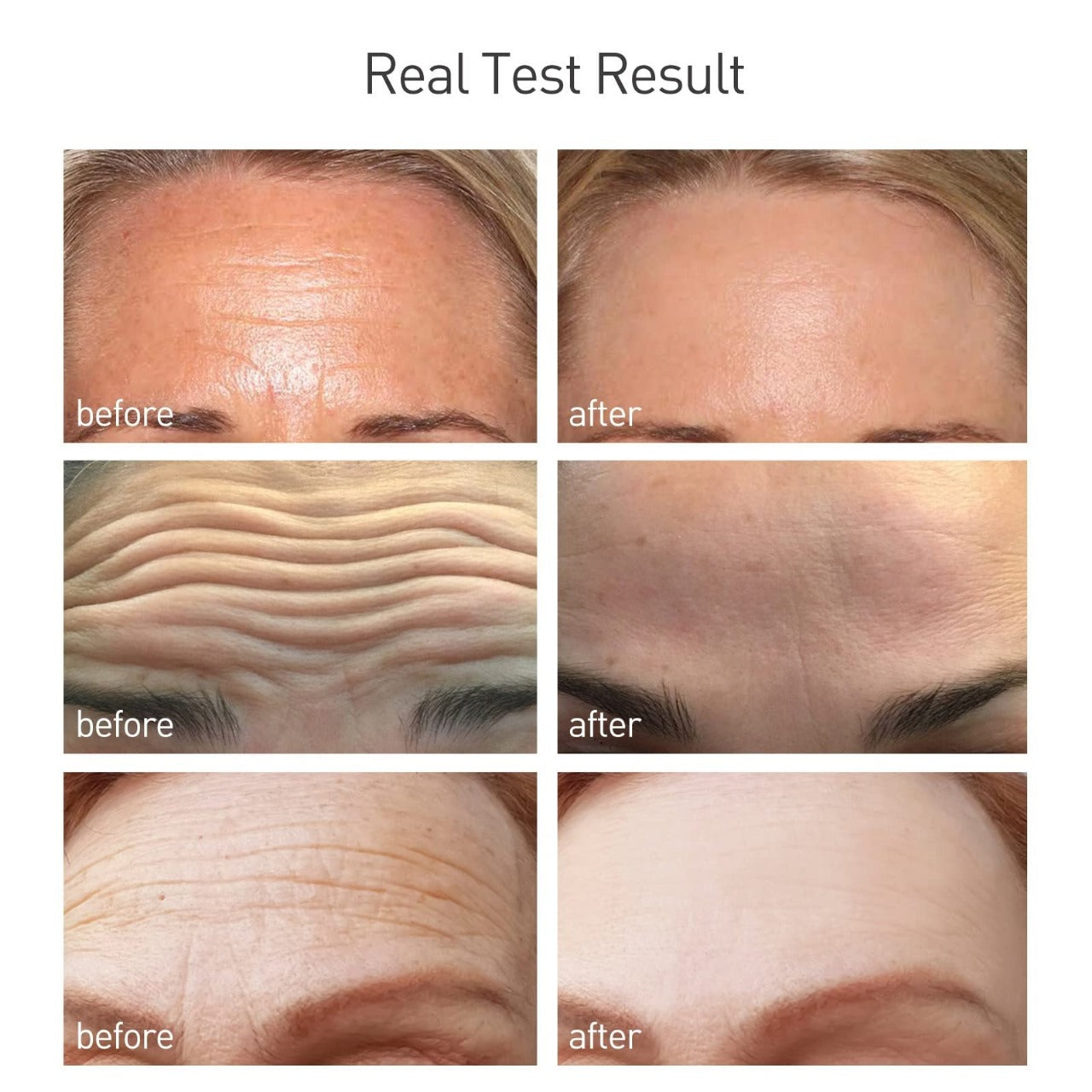 Neck and face wrinkle remover