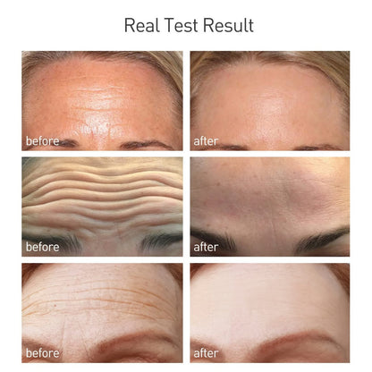 Neck and face wrinkle remover